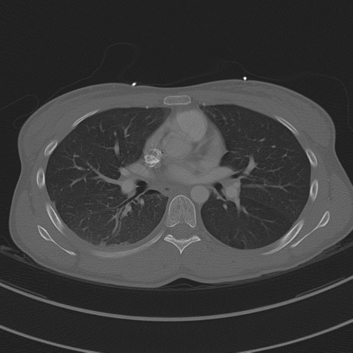 File:Abdominal multi-trauma - devascularised kidney and liver, spleen and pancreatic lacerations (Radiopaedia 34984-36486 I 42).png