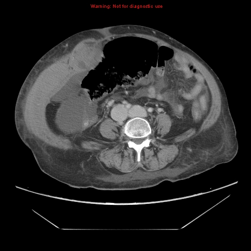 File:Abdominal wall hematoma (Radiopaedia 9427-10112 Axial C+ portal venous phase 66).jpg