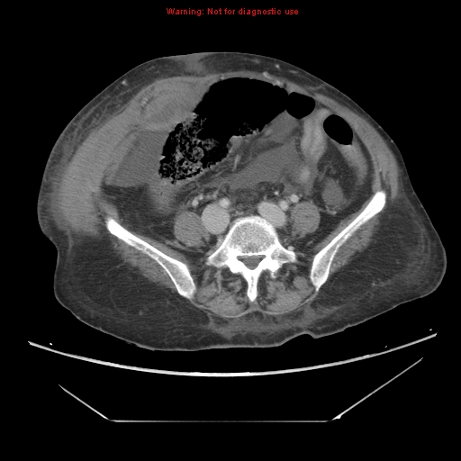 File:Abdominal wall hematoma (Radiopaedia 9427-10112 Axial C+ portal venous phase 72).jpg
