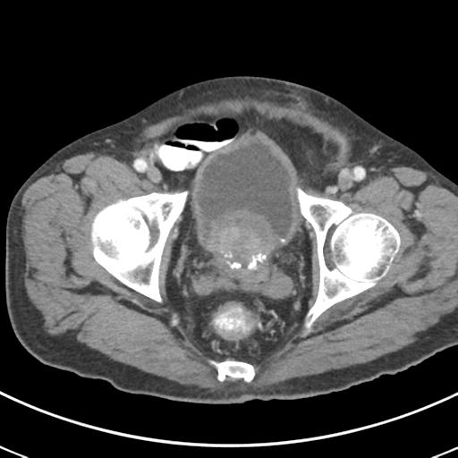 Abdominal wall metastasis from colorectal carcinoma (Radiopaedia 31016-31717 Axial C+ portal venous phase 71).jpg