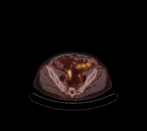 File:Abdominal wall metastasis from colorectal carcinoma (Radiopaedia 31016-31719 C 36).jpg