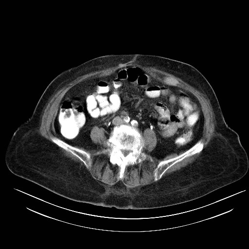 File:Abdominal wall recurrence after colorectal resection for cancer (Radiopaedia 23444-23523 Axial C+ portal venous phase 22).jpg