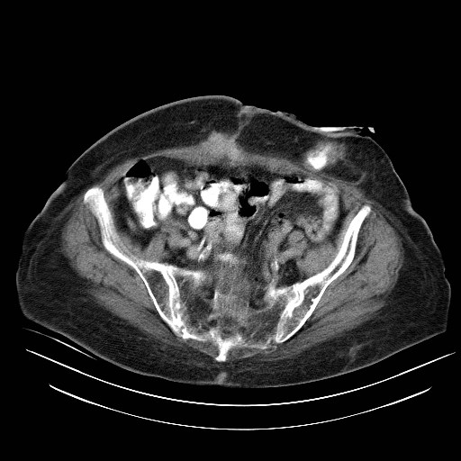 File:Abdominal wall recurrence after colorectal resection for cancer (Radiopaedia 23444-23523 Axial C+ portal venous phase 29).jpg