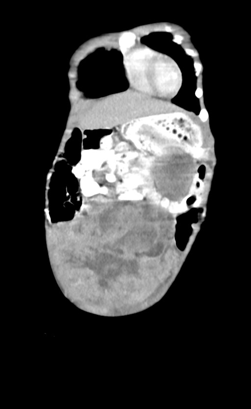Abdominopelvic rhabdomyosarcoma (Radiopaedia 78356-90984 Coronal C+ portal venous phase 16).jpg