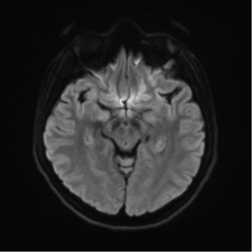 Abducens nerve palsy (Radiopaedia 51069-56648 Axial DWI 38).png
