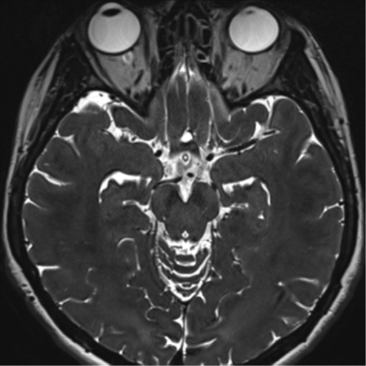 Abducens nerve palsy (Radiopaedia 51069-56648 Axial T2 fat sat 65).png