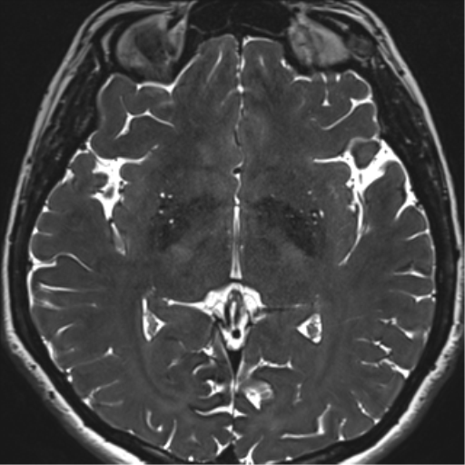 Abducens nerve palsy (Radiopaedia 51069-56648 Axial T2 fat sat 89).png