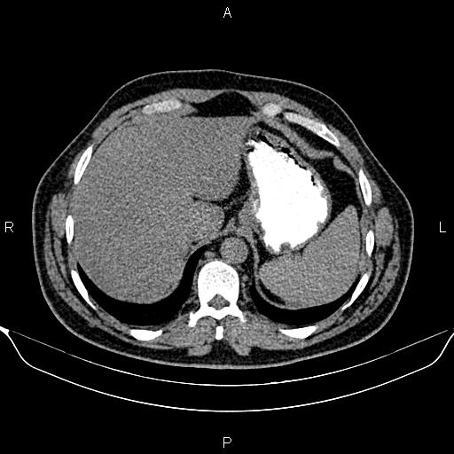 File:Aberrant right subclavian artery (Radiopaedia 87093-103354 Axial non-contrast 99).jpg
