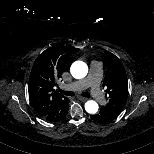 File:Aberrant right subclavian artery with Kommerell diverticulum (Radiopaedia 47982-52769 Axial C+ arterial phase 38).png