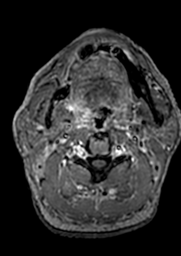 Accessory middle cerebral artery (Radiopaedia 73114-83828 Axial T1 C+ 273).jpg