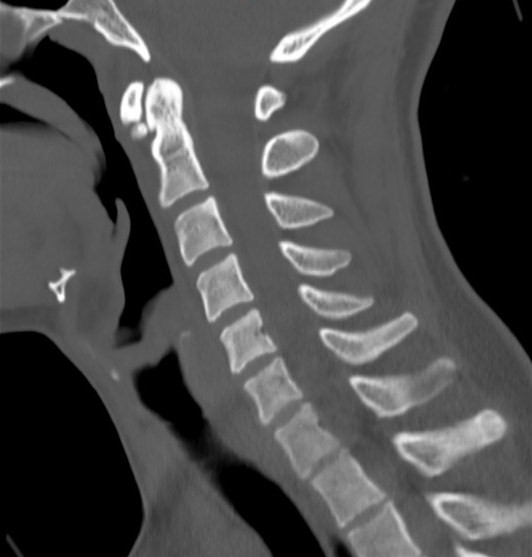 File:Accessory ossicle of the anterior arch of C1 vertebra (Radiopaedia 58149-65211 Sagittal bone window 8).jpg