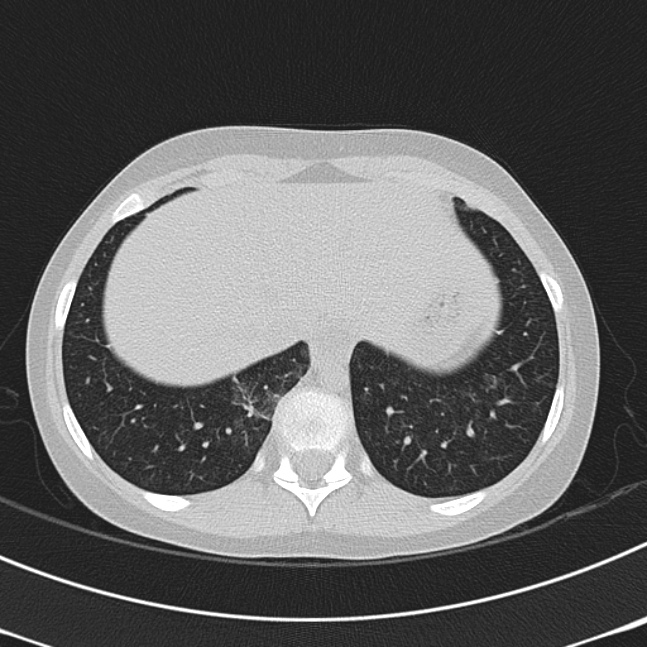 Achalasia (Radiopaedia 14946-14878 Axial lung window 68).jpg