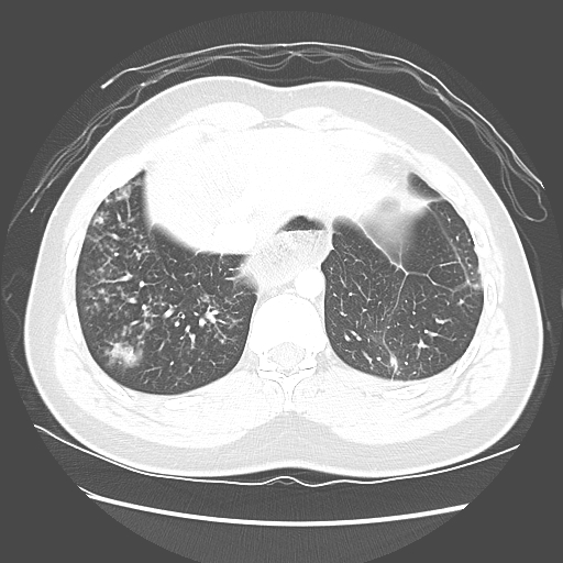 Achalasia (Radiopaedia 52507-58417 Axial lung window 52).jpg