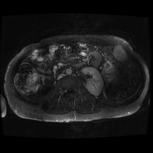 Acinar cell carcinoma of the pancreas (Radiopaedia 75442-86668 Axial T1 C+ fat sat 16).jpg