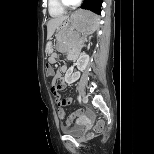 Acinar cell carcinoma of the pancreas (Radiopaedia 75442-86669 Sagittal C+ portal venous phase 115).jpg