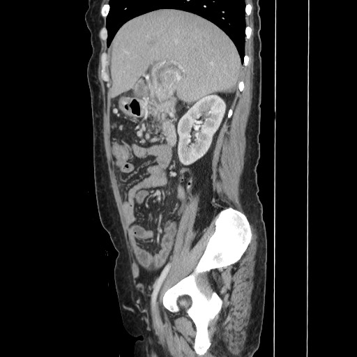 File:Acinar cell carcinoma of the pancreas (Radiopaedia 75442-86669 Sagittal C+ portal venous phase 68).jpg