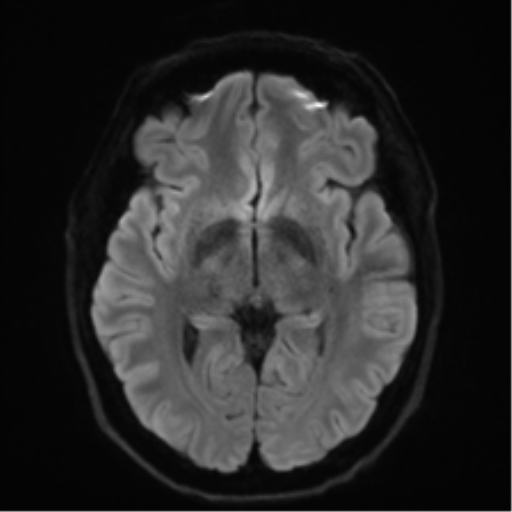 Acoustic schwannoma (Radiopaedia 50846-56358 Axial DWI 41).png
