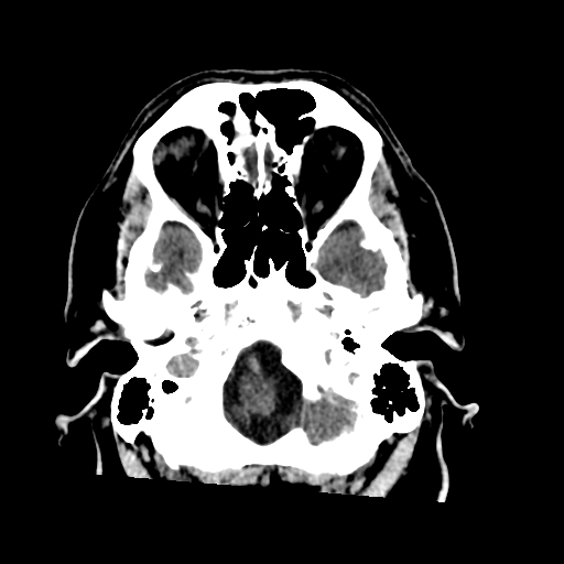 File:Acoustic schwannoma (Radiopaedia 55729-62280 Axial non-contrast 7).png