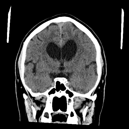 File:Acoustic schwannoma (Radiopaedia 55729-62280 Coronal non-contrast 20).png