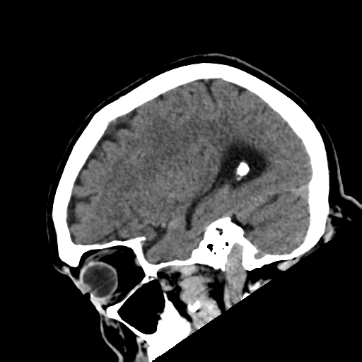 File:Acoustic schwannoma (Radiopaedia 55729-62280 Sagittal non-contrast 10).png