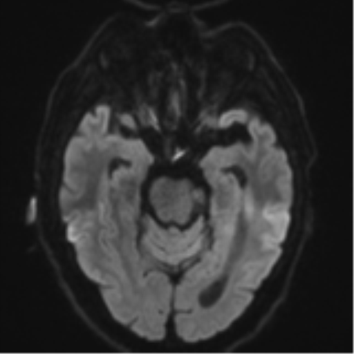 Acoustic schwannoma (Radiopaedia 55729-62281 E 36).png