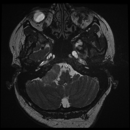 Acoustic schwannoma (Radiopaedia 57574-64536 Axial T2 17).png