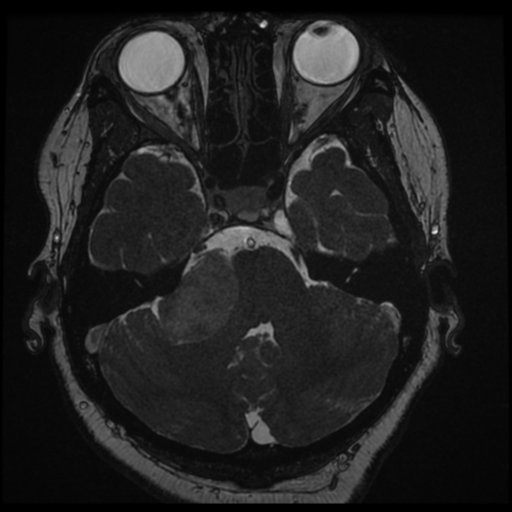 Acoustic schwannoma (Radiopaedia 57574-64536 Axial T2 44).png