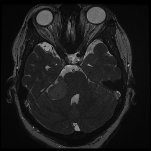 Acoustic schwannoma (Radiopaedia 57574-64536 Axial T2 56).png