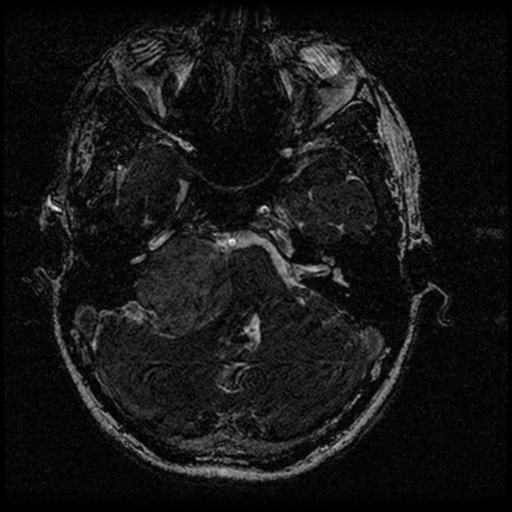 Acoustic schwannoma - eroding petrous apex (Radiopaedia 39674-42004 Axial T2 33).png