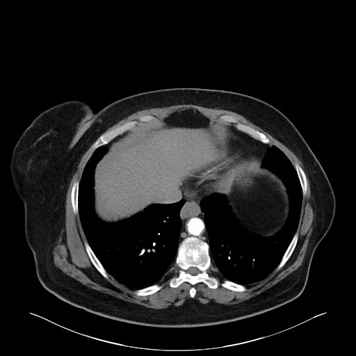File:Acromioclavicular joint cyst (Radiopaedia 58455-65610 Axial 48).jpg