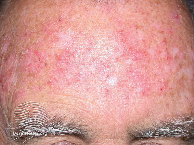 Actinic Keratoses treated with imiquimod (DermNet NZ lesions-ak-imiquimod-3754).jpg