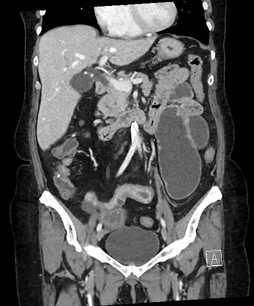 Active Crohn disease (Radiopaedia 59394-66750 Coronal C+ portal venous phase 34).jpg