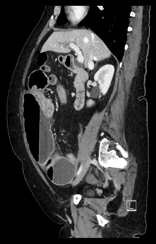 Active Crohn disease (Radiopaedia 59394-66750 Sagittal C+ portal venous phase 36).jpg