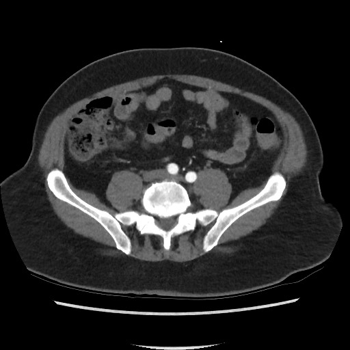 Active colonic bleed on CT (Radiopaedia 49765-55025 Axial C+ arterial phase 56).jpg