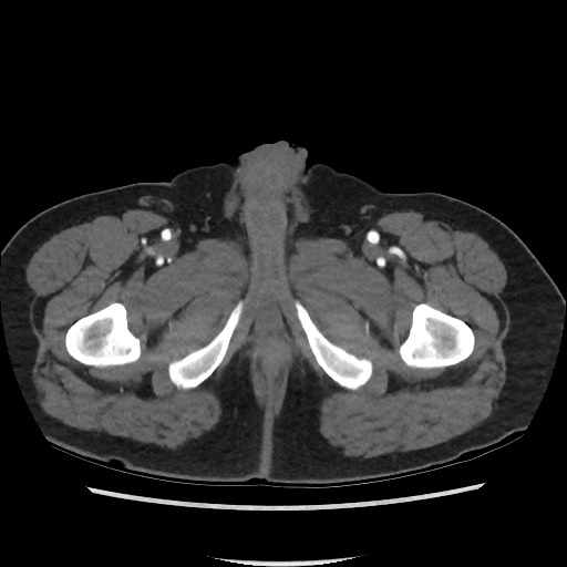 Active colonic bleed on CT (Radiopaedia 49765-55025 Axial C+ arterial phase 90).jpg