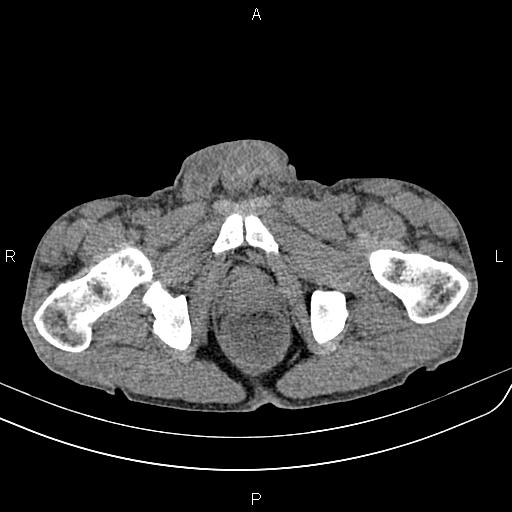 Active crohn disease (Radiopaedia 87133-103397 Axial non-contrast 104).jpg