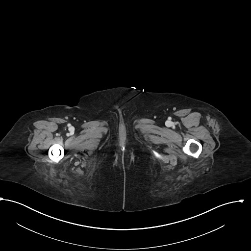 File:Active renal extravasation with large subcapsular and retroperitoneal hemorrhage (Radiopaedia 60975-68796 Axial 366).jpg