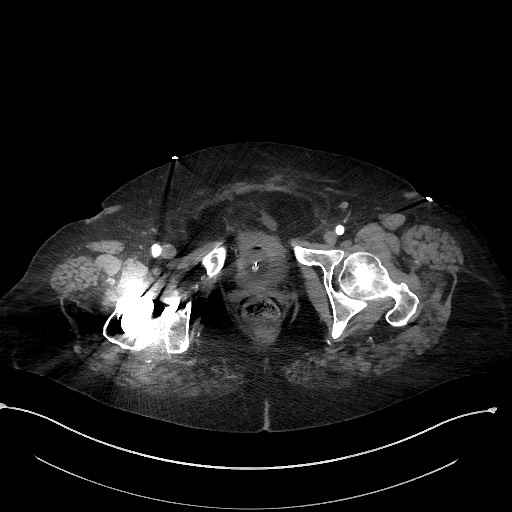 Active renal extravasation with large subcapsular and retroperitoneal hemorrhage (Radiopaedia 60975-68796 Axial C+ arterial phase 192).jpg
