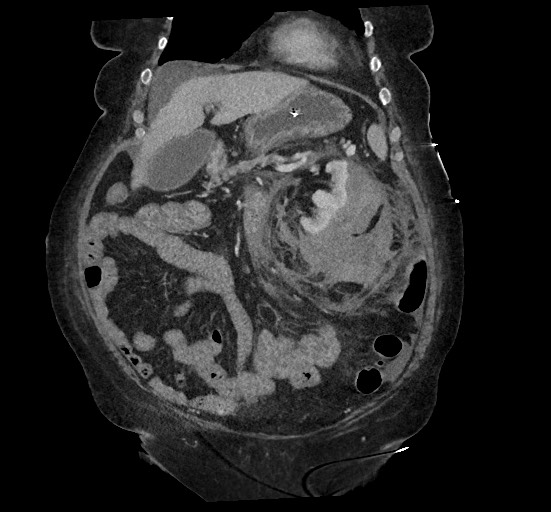 File:Active renal extravasation with large subcapsular and retroperitoneal hemorrhage (Radiopaedia 60975-68796 Coronal C+ portal venous phase 53).jpg