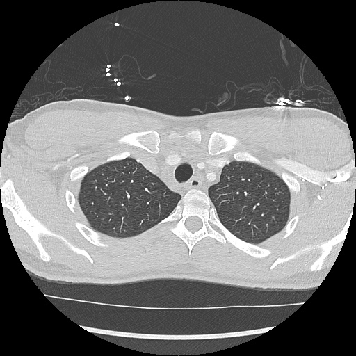 File:Active right ventricular cardiac sarcoidosis (Radiopaedia 55596-62101 Axial lung window 3).jpg
