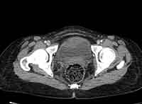 Acute Budd-Chiari syndrome (Radiopaedia 60858-68638 A 287).jpg