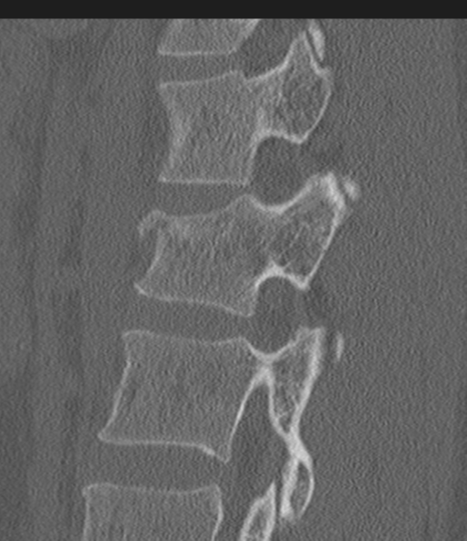 Acute L1 burst compression fracture (Radiopaedia 34430-35755 Sagittal bone window 43).png