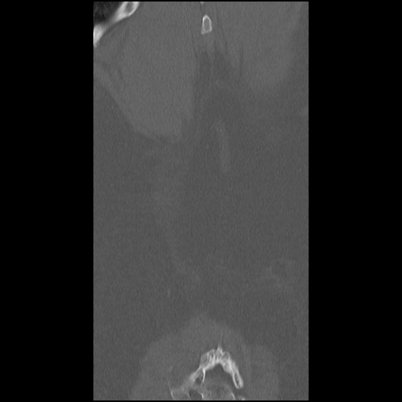 Acute Schmorl's node (Radiopaedia 83276-102365 Coronal bone window 59).jpg