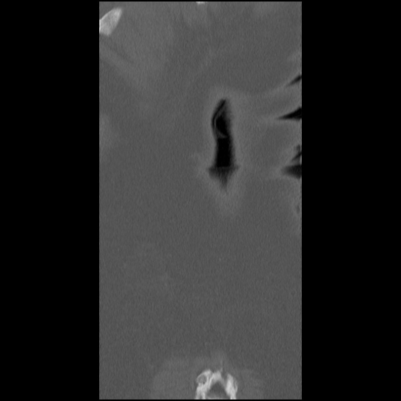 Acute Schmorl's node (Radiopaedia 83276-102365 Coronal bone window 62).jpg