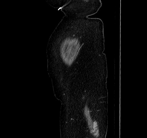 Acute appendicitis, heterotaxy syndrome (Radiopaedia 66884-76202 Sagittal C+ portal venous phase 15).jpg