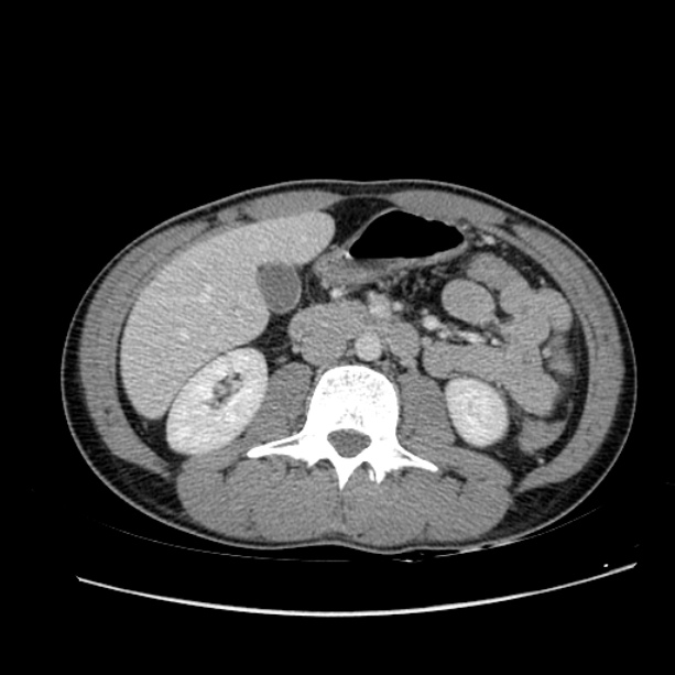 Acute appendicitis (Radiopaedia 27049-27227 Axial C+ portal venous phase 32).jpg