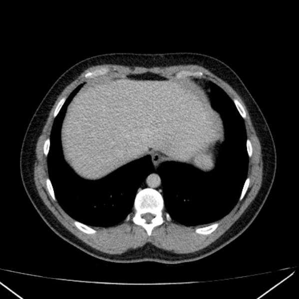 File:Acute appendicitis (Radiopaedia 38255-40270 Axial C+ portal venous phase 10).jpg