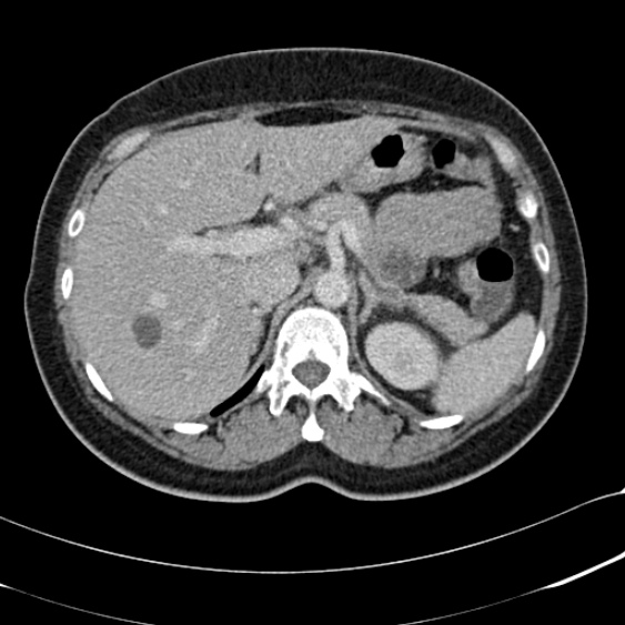 File:Acute appendicitis (Radiopaedia 48792-53822 Axial C+ portal venous phase 29).jpg