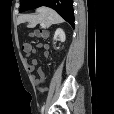 Acute appendicitis (Radiopaedia 66513-75790 Sagittal C+ portal venous phase 53).jpg