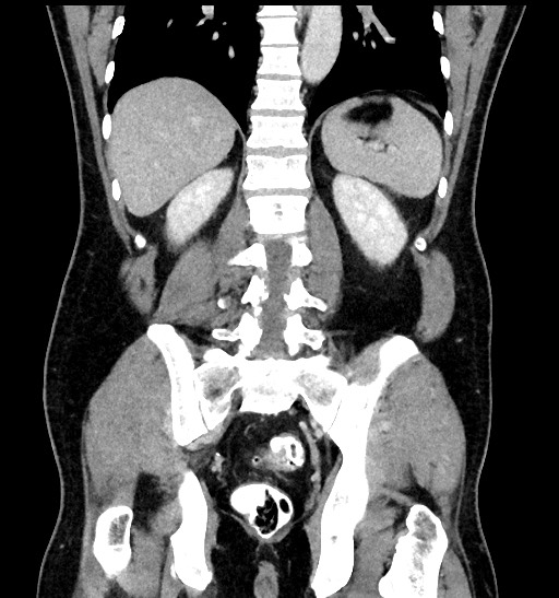 Acute appendicitis (Radiopaedia 77016-88960 Coronal C+ portal venous phase 70).jpg